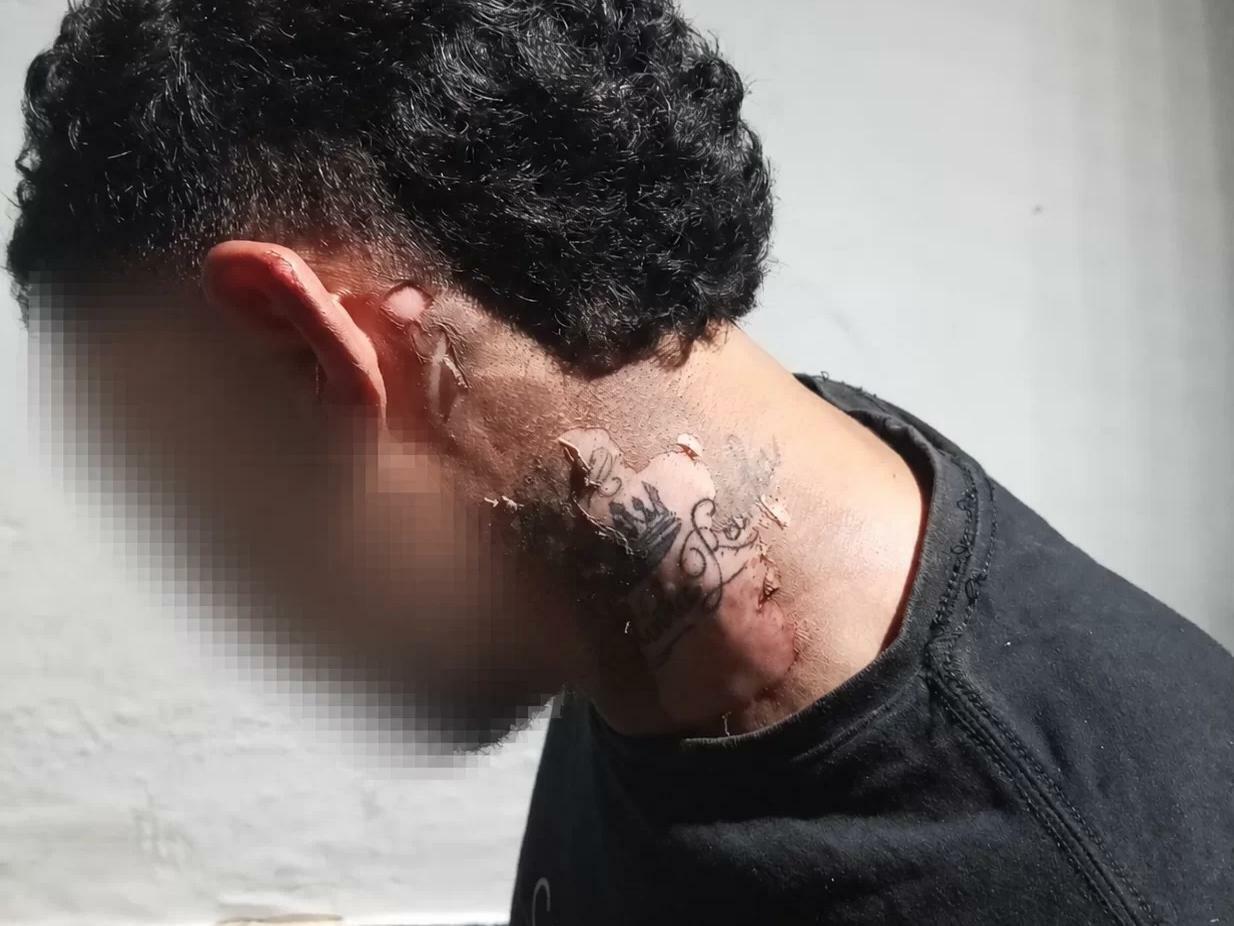 Homem sofre queimaduras após ser atingido por óleo quente em Parauapebas.